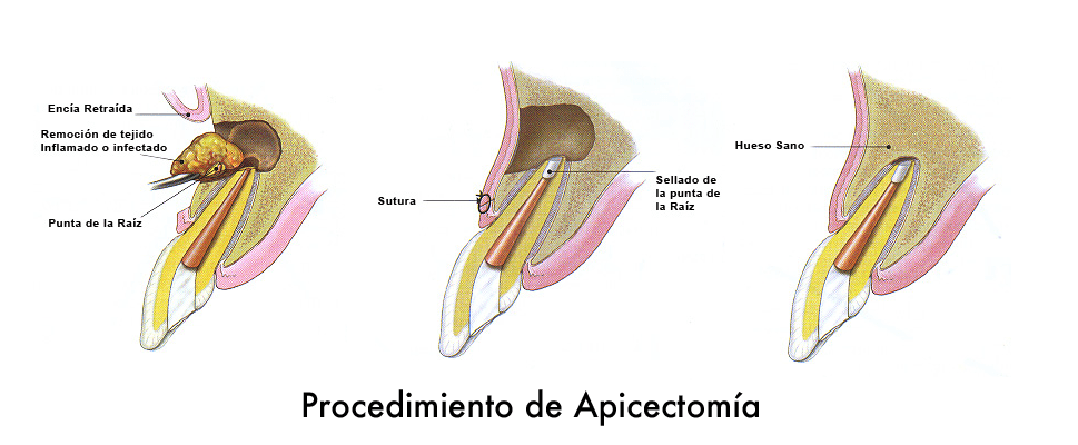 apicectomia-