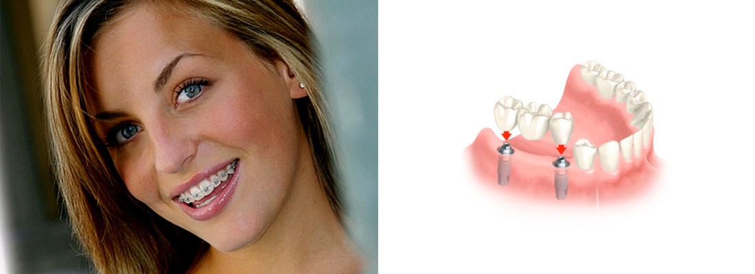 Clínica dental Madrid implantes